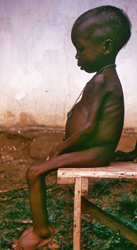 starving girl - from the Centers for Disease Control and Prevention